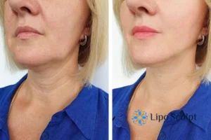Double chin before and after Hi-Fu treatment 4 Book your double chin treatment Market Bosworth today! We are here to help!