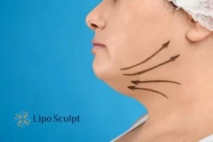 Double chin before and after Hi-Fu treatment 3 Boost your confidence with a Double chin treatment Market Bosworth