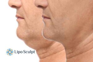 Double chin before and after Hi-Fu treatment 2 Double chin treatment Market Bosworth from Lipo Sculpt - feel more confident today!