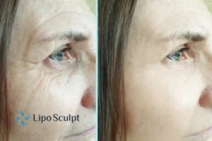 How to Fight Aging Symptoms 2 Do you want to Fight Aging Symptoms Market Bosworth? Contact Lipo Sculpt today!