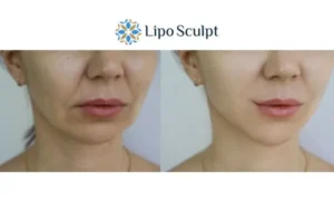 Explaining Total Skin Tightening Treatment And What It Can Do For You 2 Do you want to boost your self confidence? Give Morpheus8 Market Bosworth a try today!
