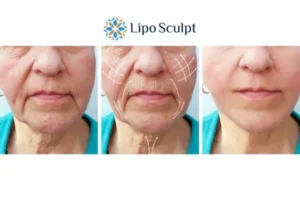 Explaining Total Skin Tightening Treatment And What It Can Do For You 3 Boost your confidence with Morpheus8 Market Bosworth call our team today!