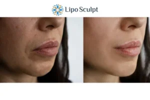 Explaining Total Skin Tightening Treatment And What It Can Do For You 4 Morpheus8 Market Bosworth the best results - call our team today!