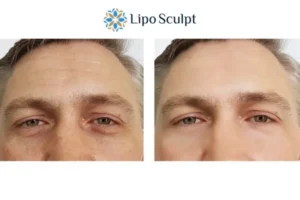 Explaining Total Skin Tightening Treatment And What It Can Do For You 6 Morpheus8 Market Bosworth book in today to find out more!