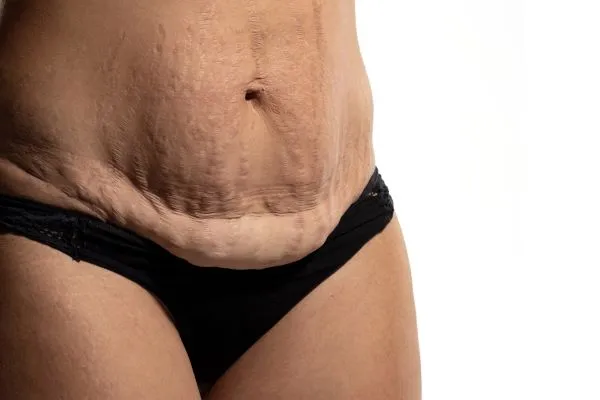 Lost the Weight but Not the Loose Skin? 1 image of womans stomach after weight loss showing loose skin Market Bosworth